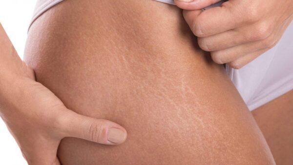 Rạn da thường xuất hiện ở nhiều vùng trên cơ thể