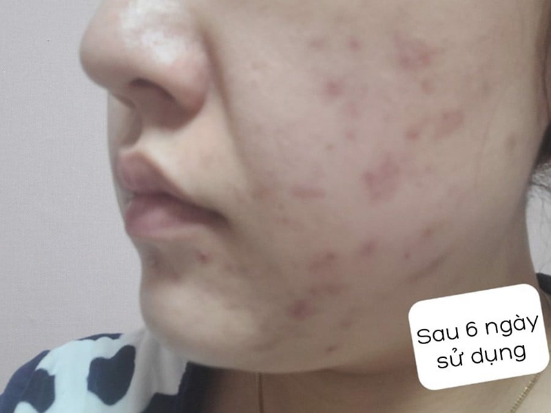 Serum Skin1004 Tinh Chất Rau Má Làm Dịu, Hỗ Trợ Dưỡng Sáng, Mờ Thâm Cho Da Nhạy Cảm Skin1004 Madagascar Centella Asiatica 100 Ampoule