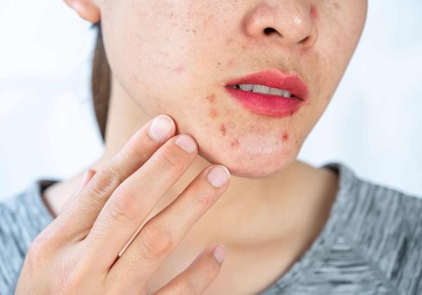 Vết thâm mụn hình thành do các tổn thương trên da