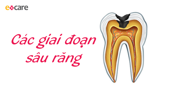 Các giai đoạn sâu răng