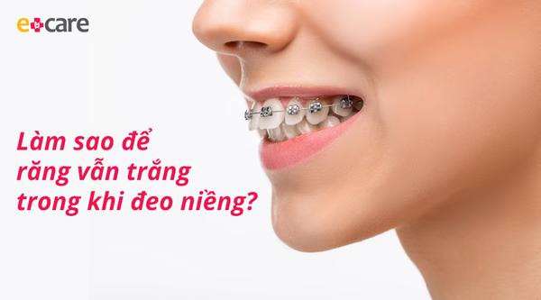 Làm sao để răng vẫn trắng đẹp khi đeo niềng?