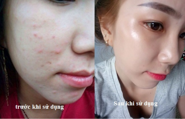 Thuốc rượu trị mụn gia truyền