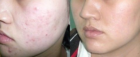 Thuốc rượu trị mụn gia truyền