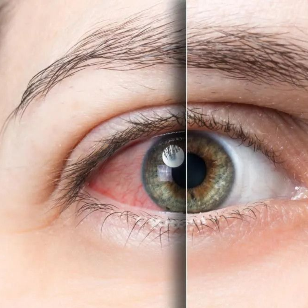 Đeo Lens Quá 8 Tiếng Có Sao Không? Chuyên Gia Nhãn Khoa Cảnh Báo Điều Gì?