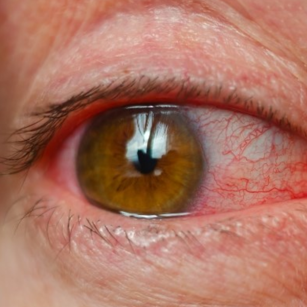Đeo Lens Hết Hạn Có Sao Không? Cảnh Báo Nguy Hiểm Từ Thói Quen Chủ Quan