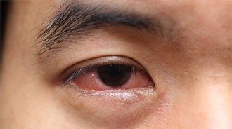 Sự thật việc đeo kính áp tròng có lợi hay hại cho mắt