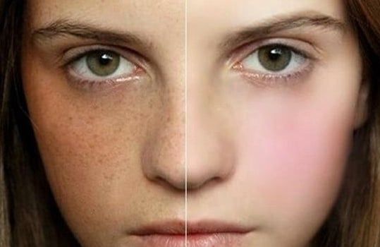 TRỊ NÁM TRIỆT ĐỂ BẰNG CHẾ ĐỘ DINH DƯỠNG HỢP LÝ?