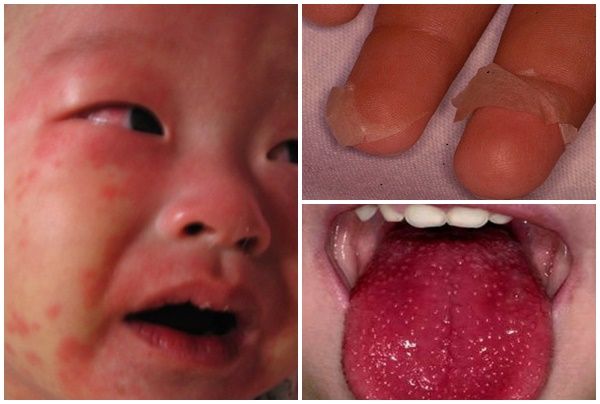 Kawashaki căn bệnh nguy hiểm cho trẻ - cách nhận biết và chữa trị