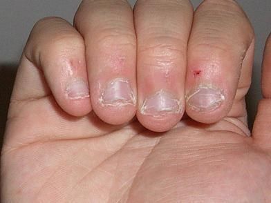 5 BƯỚC GIÚP TRẺ BỎ THÓI QUEN CẮN MÓNG TAY