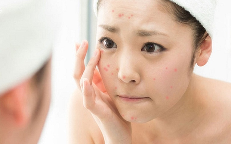 Tổ yến có công dụng trị mụn không?