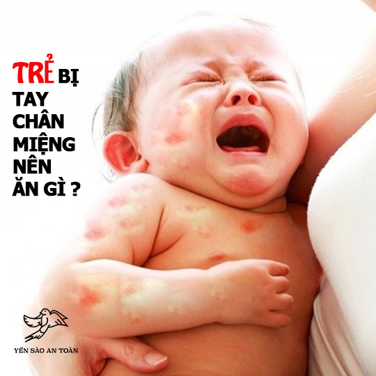 Trẻ bị tay chân miệng nên ăn gì ?
