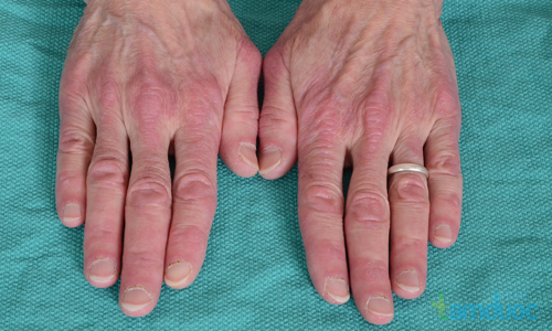 Đau nhức xương khớp là dấu hiệu của những bệnh nguy hiểm