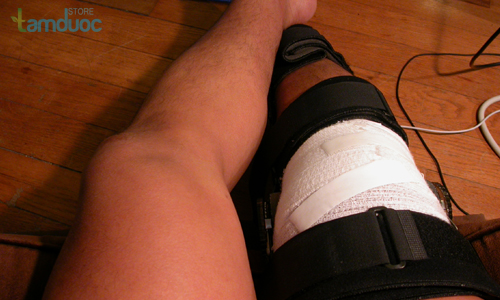 Nguyên nhân - Triệu chứng và cách phòng ngừa viêm khớp mãn tính