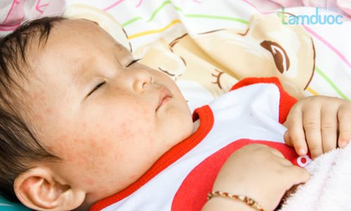 Sốt phát ban ở trẻ và những điều cần biết