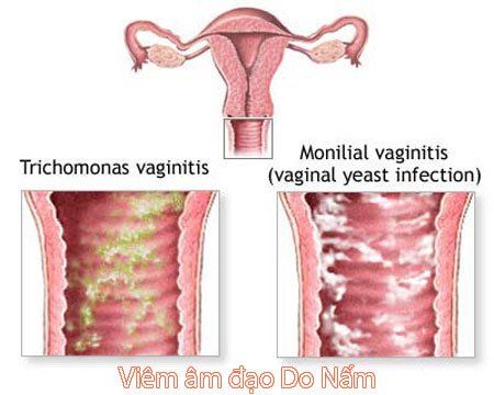 Viêm nhiễm phụ khoa dai dẳng – tại sao?