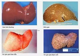 XƠ GAN- NGUY CƠ TIỀM ẨN CỦA UNG THƯ GAN