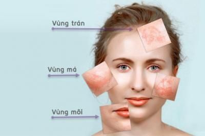 Nám da và phác đồ điều trị ‘chuẩn không cần chỉnh’