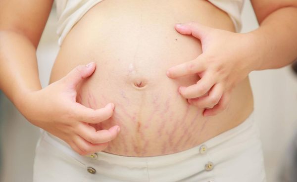 Xử lý dị ứng da khi mang thai giúp mẹ bầu hết ngứa nhanh chóng