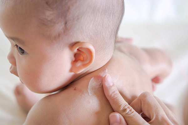 Tất Tần Tật Về Chàm Da Ở Trẻ Sơ Sinh Và Trẻ Nhỏ
