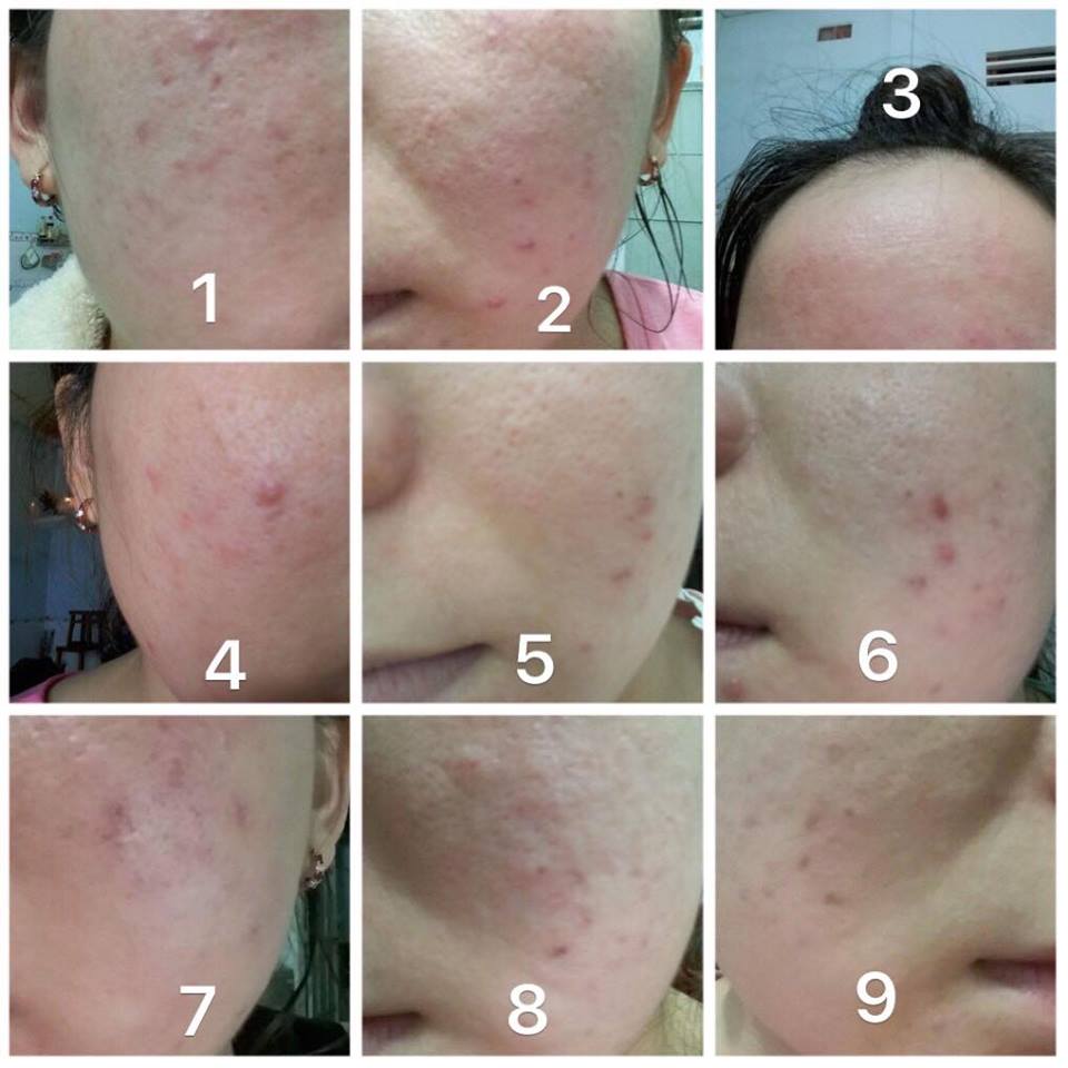 Tư Vấn Trường Hợp Da Cực Kỳ Nhạy Cảm