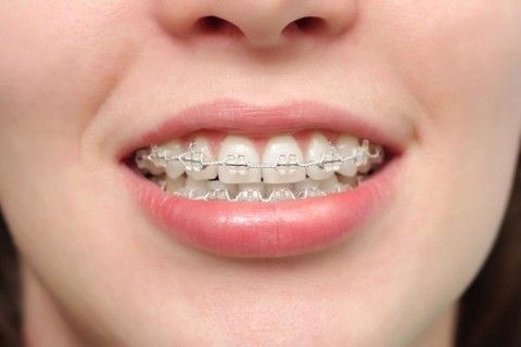 how long does it take to wear braces