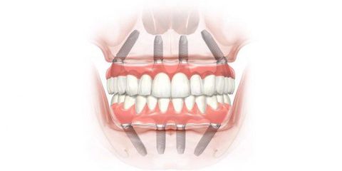 all on 4 implant the golden choice for teeth loss patients