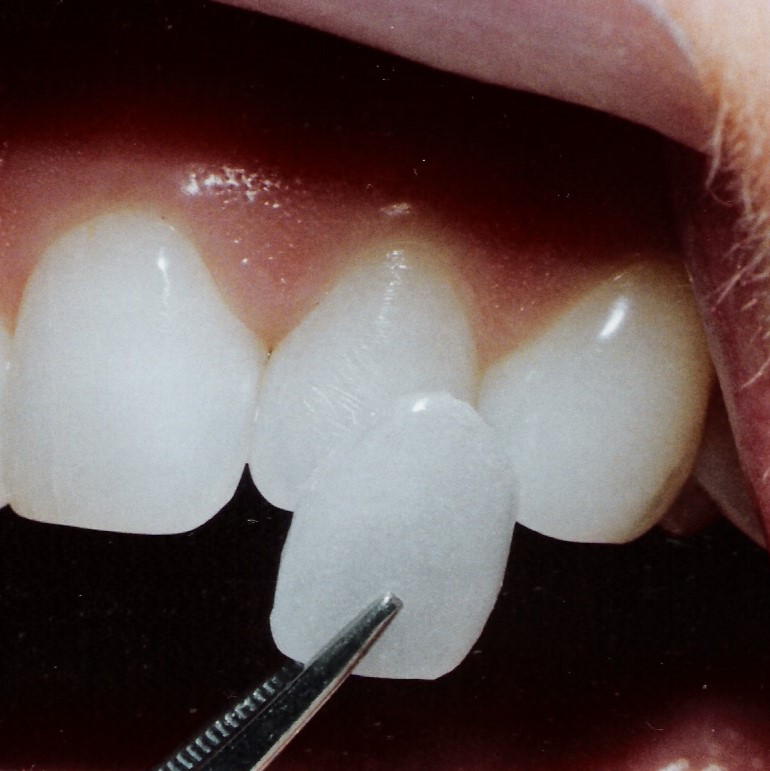 tooth pasting