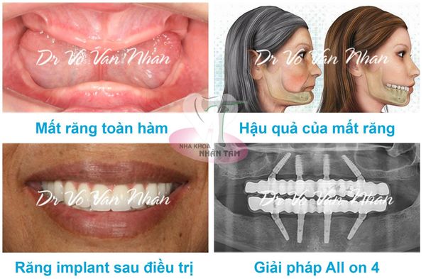 Trồng răng implant All on 4 - lựa chọn hàng đầu khi bị mất răng toàn hàm