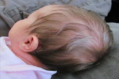 Điểm nguyên nhân gây bạc tóc ở trẻ em