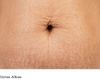 RẠN DA (STRETCH MARKS) - NGUYÊN NHÂN VÀ HƯỚNG ĐIỀU TRỊ RẠN DA (STRETCH MARKS) - NGUYÊN NHÂN VÀ HƯỚNG ĐIỀU TRỊ