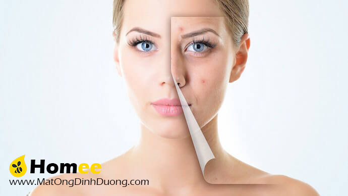 LÀM ĐẸP BẰNG MẬT ONG: TRỊ MỤN TRỨNG CÁ BẰNG MẬT ONG VÀ CHUỐI