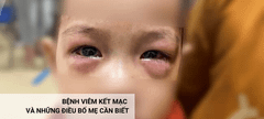 BỆNH VIÊM KẾT MẠC CẤP (ĐAU MẮT ĐỎ) – NHỮNG ĐIỀU CHA MẸ CẦN BIẾT