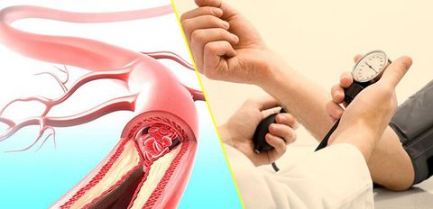 Phòng ngừa bệnh tăng huyết áp- Cách nào?