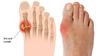 Bệnh Gout là gì? Nguyên nhân, triệu chứng và điều trị hiệu quả