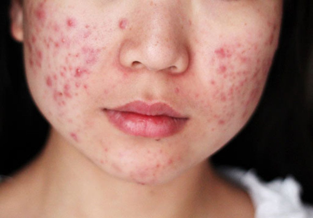 Những sai lầm khi điều trị mụn