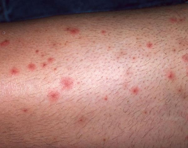 Trị viêm lỗ chân lông (body)