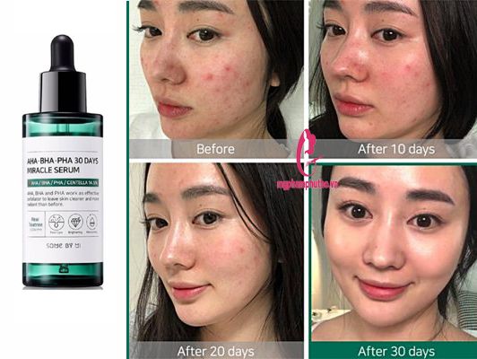 Review Tinh chất Serum trị mụn Some By Mi AHA-BHA-PHA 30 Days