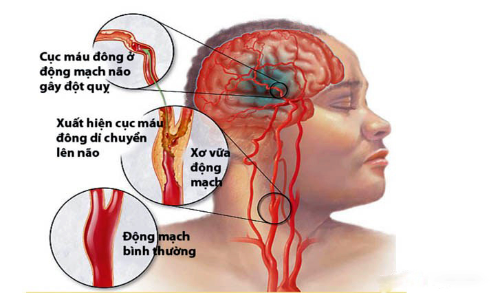 Căn bệnh phổ biến dễ phòng ngừa gây ra 80% ca đột quỵ ở Việt Nam