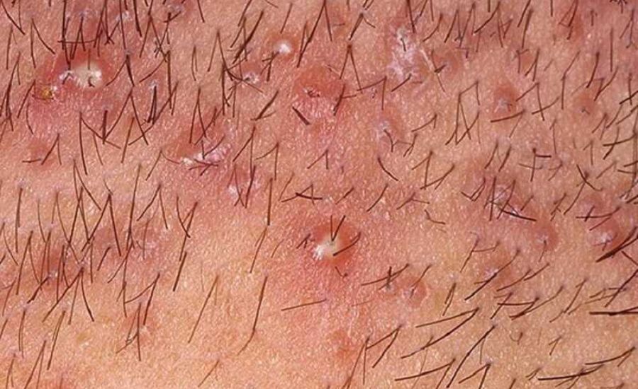 Các loại mụn thường gặp ở vùng kín