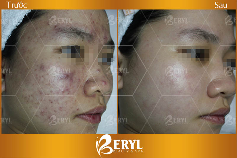Trước và sau khi điều trị mụn hiệu quả tại Beryl Beauty & Spa.