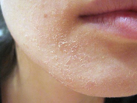 Cách chăm sóc da mặt khô và ngứa