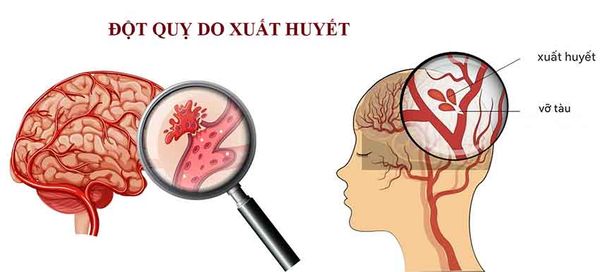 đột quỵ, vai trò hydro