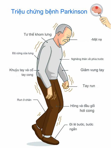 Bệnh Parkinson