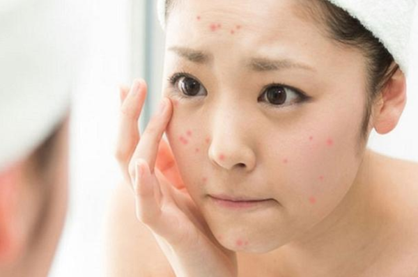 Skincare cho da mụn cải thiện tình trạng mụn