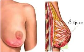 ÁP XE VÚ VÀ NHỮNG ĐIỀU MẸ NUÔI CON CẦN BIẾT