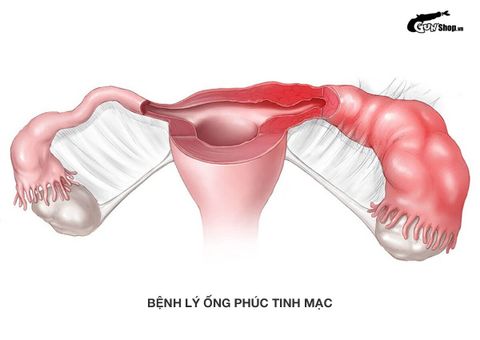 Bệnh lý ống phúc tinh mạc là gì? Nguyên nhân và cách phòng ngừa