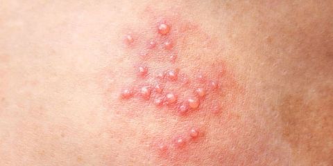 Herpes sinh dục kiêng ăn gì? Mụn rộp sinh dục nên ăn gì?
