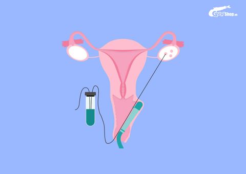 Sau chọc hút trứng bao lâu thì quan hệ được? Cần lưu ý gì?