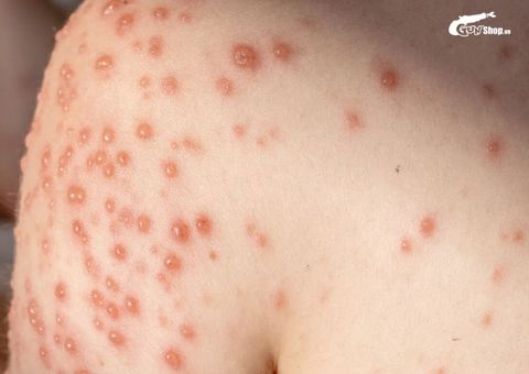 Thủy đậu có gây vô sinh không? Những lưu ý khi mắc phải thủy đậu