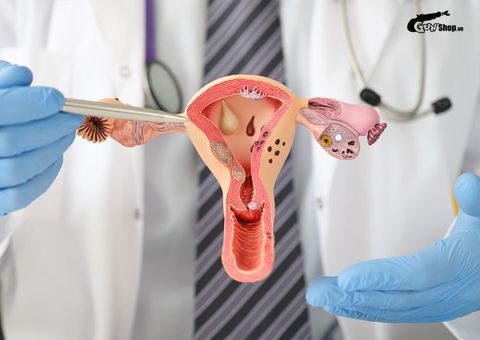 Tuổi thọ của người cắt tử cung và buồng trứng có giảm không?